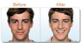  Neutrogena Complete Acne Therapy System Beauty